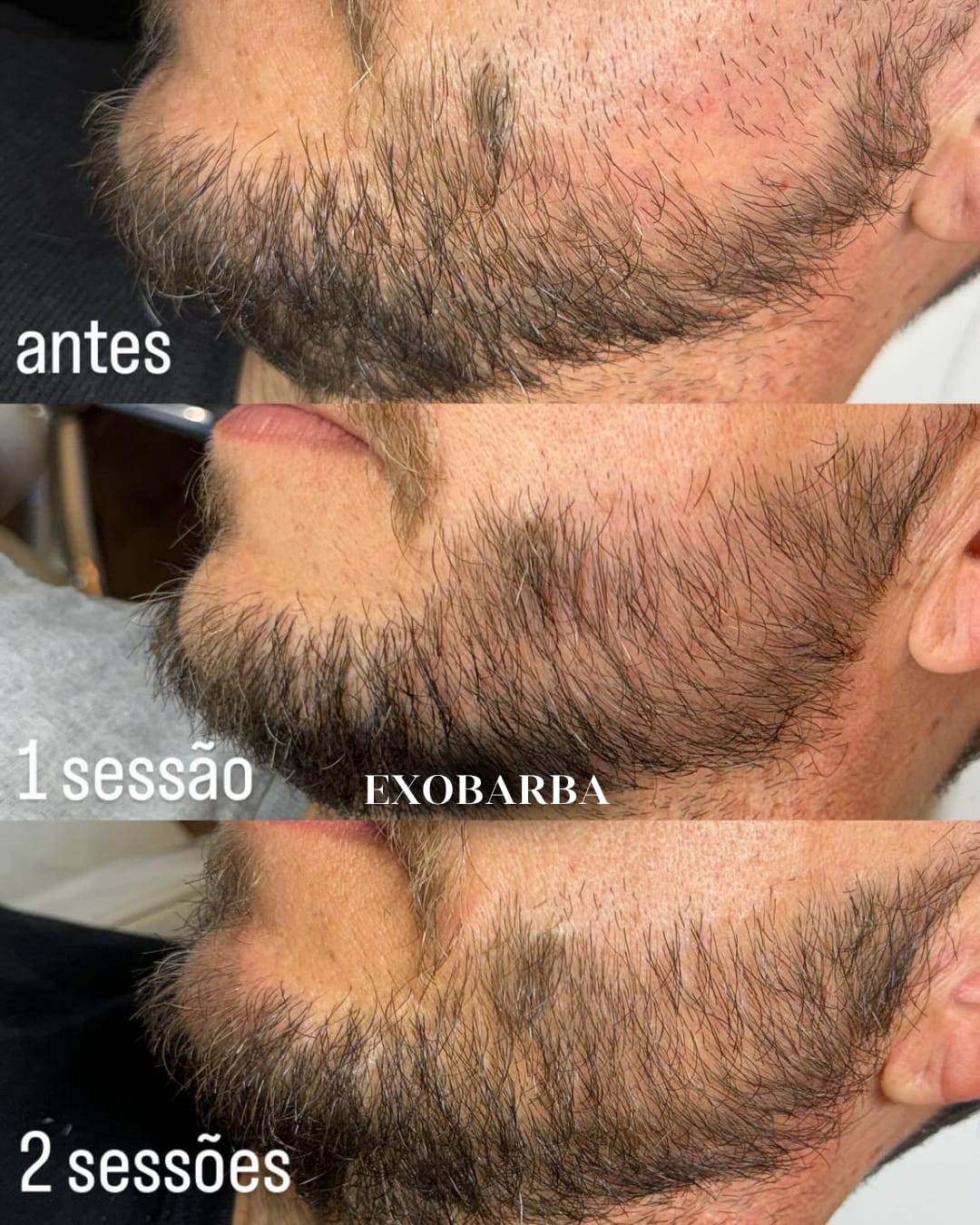 Antes e depois de regeneração de barba
