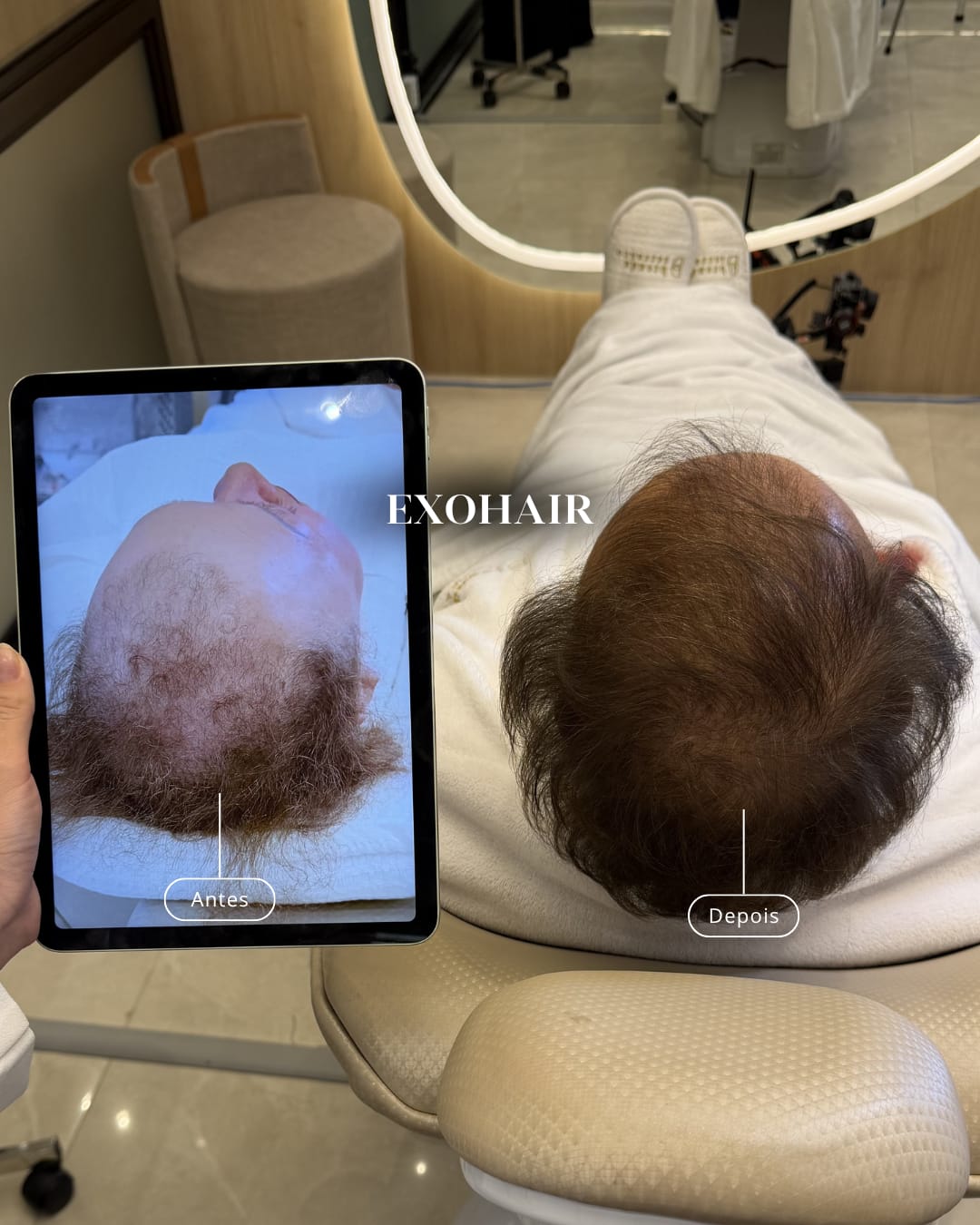 Antes e depois de regeneração capilar realizado na Traço Fino