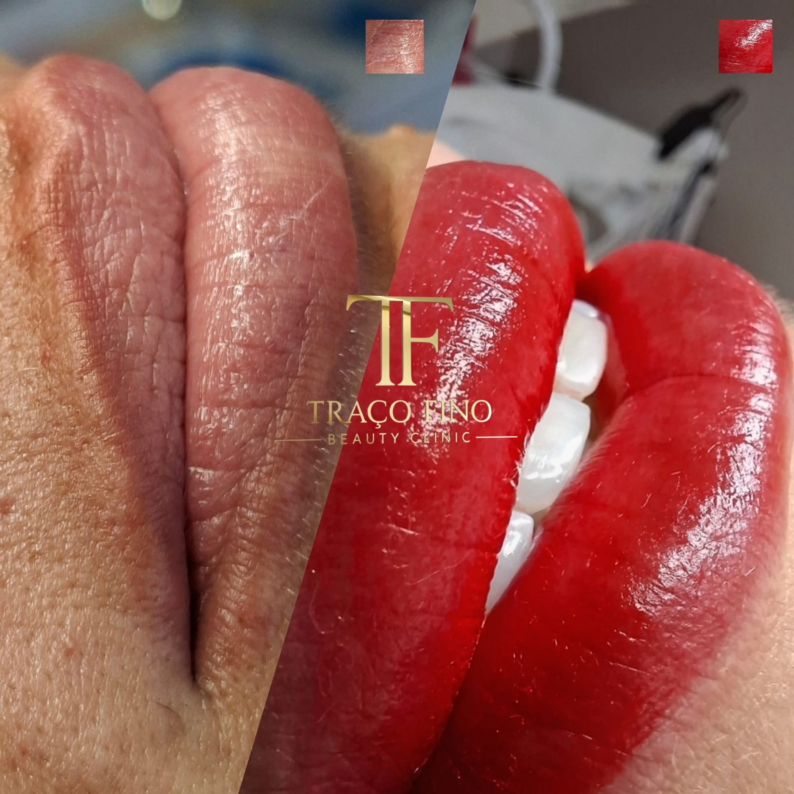 Antes e depois de micropigmentação labial